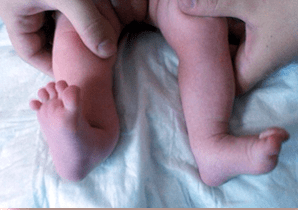 Valgus deformation in children Symptoms
