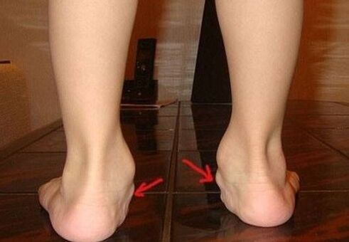 Valgus foot deformation in children