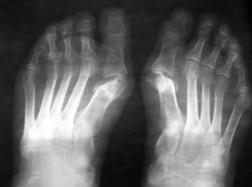 Indications for operations under the feet valgus