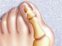 Hallux Deformy Valgus