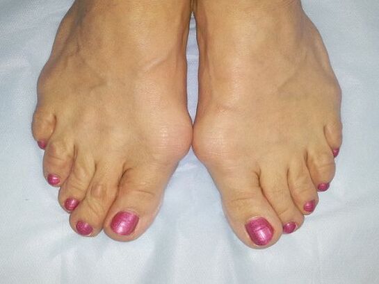Hallux Valgus Foot deformity